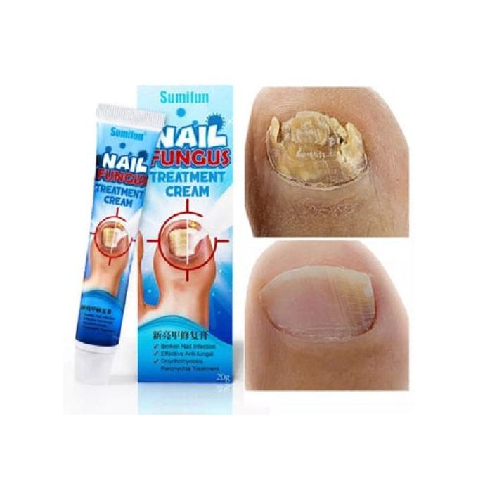 كريم علاج فطريات الأظافرPro™ NailRegen